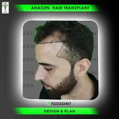 A side profile view of the hairline design and planning phase. We take great care to ensure the new hairline will perfectly frame the face and blend seamlessly with existing hair.