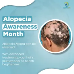 It's important to know that Alopecia Areata can often be reversed. With advanced treatments, we can help you on your journey back to hair health.