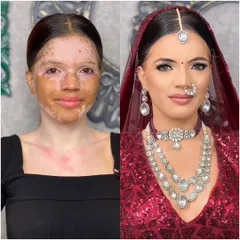 I believe every skin is beautiful, and makeup is a tool to celebrate it. This is a powerful before and after transformation for a client with vitiligo, showing how I create a smooth, even-toned, and radiant bridal look while respecting and honouring her unique skin.
