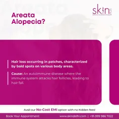 Understanding the cause of your hair loss is the first step. This graphic explains that Areata Alopecia is an autoimmune disease where the immune system attacks hair follicles, leading to patchy hair fall.