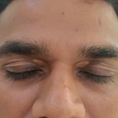 A before-photo of a patient with Xanthelasma on both eyelids. These yellowish deposits are effectively and safely removed with laser treatment.