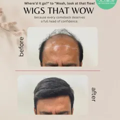 For those seeking an immediate and dramatic change without surgery, I offer custom hair systems. This before and after showcases a complete transformation, providing a full head of hair that blends seamlessly and restores confidence instantly.