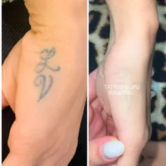 A clear before and after of initials removed from the side of the hand. This area has thin skin, but with careful work, we can achieve great results with minimal scarring.