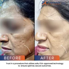 A closer look at the improvement in skin texture and the softening of deep rolling scars. This result was achieved using safe, FDA-approved technology.