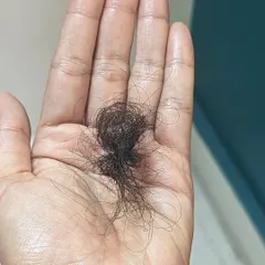 A closer look at what a normal amount of daily hair shedding looks like when collected. If your daily hair loss is significantly more than this, it's time to consult a dermatologist.