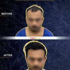 This is a clear before-and-after of Naseem's hair restoration. The top image shows the extent of his hair loss in the frontal and central zones before the procedure.