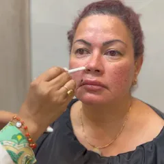 Here, I am marking the treatment area for a threadlift designed to address nasolabial lines, the lines that run from the nose to the corners of the mouth. Proper planning is crucial for targeting specific areas of concern.