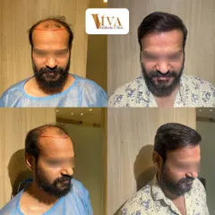 A closer look at the transformation. Seeing my patients happy with their natural, fuller hair is the ultimate reward for the detailed work we put in.