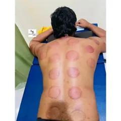 These marks are the result of a successful cupping therapy session. They indicate areas where blood flow was stagnant and are a normal part of the healing process, fading within a few days as the muscles recover.
