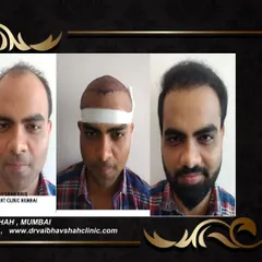 A frontal view of the same patient's journey. Seeing the intermediate step helps set realistic expectations for the recovery and growth timeline.
