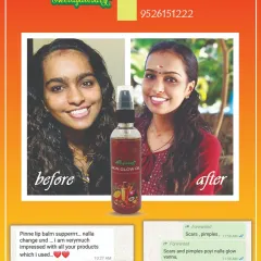 This is the result that makes all my hard work worth it. You can see how our Ayurvedic Skin Glow Oil helped reduce scars and pimples, bringing out a natural, healthy glow. Seeing this kind of happiness in my customers is my biggest reward.