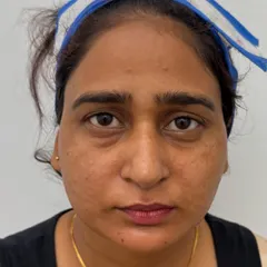 This is the "before" photo of a patient who was concerned about her tired appearance due to under-eye hollows before her wedding.