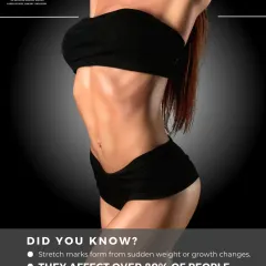 Did you know stretch marks affect over 80% of people? They often form from sudden weight or growth changes, but you don't have to live with them. Our BodyShock Mesoestetic treatment can help.
