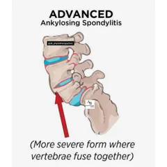 The terms spondylitis, spondylolysis, and spondylolisthesis can be confusing. We clarify the differences between these spinal conditions, from inflammation and fused vertebrae to stress fractures and slipped vertebrae.