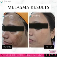 This is a powerful example of melasma reduction. My treatment plan, often involving the Q-Switch laser, targets these stubborn patches of pigmentation to significantly lighten them and restore an even skin tone.