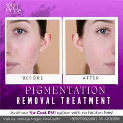 A clear example of how our pigmentation removal treatments work. We target dark spots and uneven tone to reveal a brighter, smoother complexion underneath.