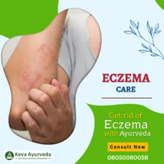 Get rid of Eczema with Ayurveda. This condition is often triggered by an imbalance of the pitta dosha, and we offer treatments to address the root cause and soothe the skin.