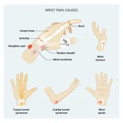 Wrist pain can have many causes, from carpal tunnel and arthritis to ganglion cysts and sprains. This guide illustrates some of the most common conditions we diagnose and treat.