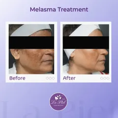Melasma can be a persistent concern, but with a consistent and correct treatment plan, significant improvement is possible. This image shows a visible reduction in melasmic patches, leading to a clearer and more balanced complexion.