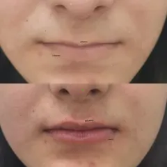 A clear before and after comparison of a lip filler treatment. Notice the improved volume and symmetry, which brings a youthful and refreshed look to the entire lower face.