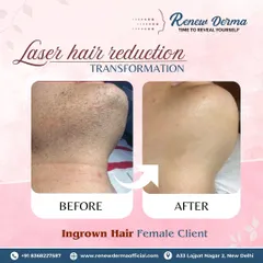 This is why I love what I do. We helped this client get rid of painful and persistent ingrown hair on her chin and neck area. The 'after' photo shows completely clear, smooth skin with no more irritation, a common result of our precise laser hair reduction treatment.