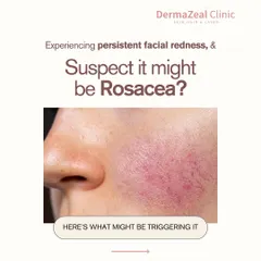 Experiencing persistent facial redness and suspecting it might be Rosacea can be concerning. This image shows the characteristic redness on the cheek, a common symptom that I can help you manage.