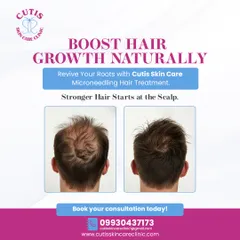 A before and after view from the back of a patient's head, showing the results of our microneedling hair treatment. The image on the left shows visible thinning at the crown, while the image on the right displays noticeably thicker and denser hair growth.