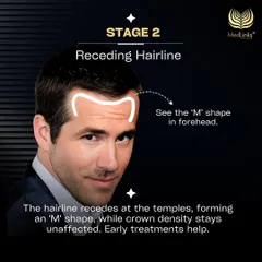 In Stage 2, the hairline recedes at the temples, forming a distinct 'M' shape. The crown density is usually unaffected, and early treatments can help slow down progression.