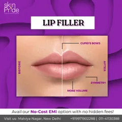 This before and after image shows how I use lip fillers to create beautiful, natural looking results. I focus on enhancing symmetry, defining the cupid's bow, and adding subtle volume for a balanced and hydrated look, bilkul aapke features ke according.