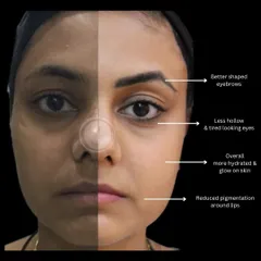Permanent eyebrows can transform your entire face. This client's journey involved a combination of treatments over time. Along with improving skin hydration and reducing pigmentation, we defined her brows. Notice how the new, better-shaped eyebrows frame her eyes, making them appear less tired and bringing a balanced look to her entire face.