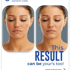 This is a result that can be yours. This before and after showcases the power of laser resurfacing for treating acne scarring and uneven texture. The treatment works by removing damaged outer skin layers and stimulating new collagen, resulting in smoother, clearer skin. This kind of transformation is possible with a targeted, professional treatment plan.