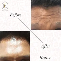 This is a great demonstration of how Botox can smooth deep-set forehead lines. My technique ensures you look refreshed and rested, not frozen, so you can still make natural expressions.