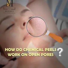 A graphic explaining how chemical peels work on open pores, a common concern I address at the clinic.