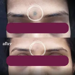 Here you can see the significant fading of a facial tattoo after a course of laser tattoo removal sessions. My approach focuses on gradually breaking down the ink pigment with each treatment, allowing the body to clear it naturally. This ensures the skin's integrity is protected while achieving clear, impressive results.