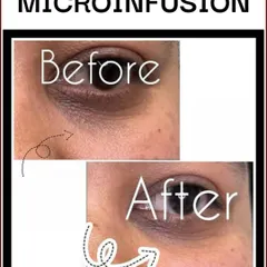Microinfusion is highly effective for the delicate under-eye area. This before-and-after shows a significant improvement in dark circles, helping my client look more refreshed and rejuvenated.
