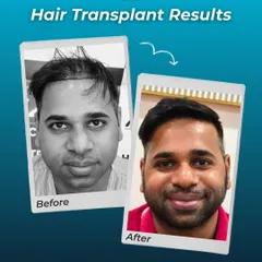 This before-and-after shot perfectly captures the goal of my work: results that look so natural they are undetectable. The restored hair blends seamlessly with his existing hair.