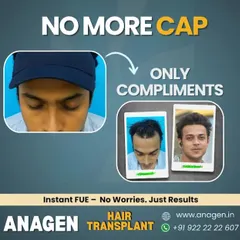 It's time to trade the cap for compliments. This patient's journey is a perfect example of how our Instant FUE technique can restore not just a hairline, but the confidence to face the world without hiding.
