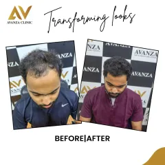 This client was experiencing thinning at the crown and a receding hairline. Our FUE hair restoration filled in these areas, resulting in a fuller, more youthful look.