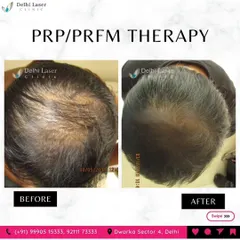 Here you can see the clear difference PRP and PRFM therapy can make. This patient's scalp was visibly thinning, and after a customized treatment plan, his hair is significantly denser and healthier. This is a non-surgical way to fight hair loss.