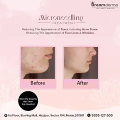 See the real-world results of our Microneedling treatment for acne scars. This before-and-after image shows a significant reduction in scar appearance and improved skin texture on the chin and jawline, demonstrating the treatment's effectiveness in skin renewal.