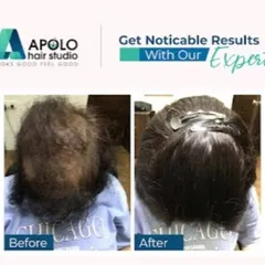 For women with thinning hair, a clip-on hair topper can make a world of difference. This before-and-after shows how we achieved noticeable results and added density with this simple solution.