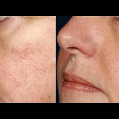 Facial telangiectasias, or small broken blood vessels, can cause persistent redness. I treat these using specific lasers that target the vessels and erase them without harming the surrounding skin, resulting in a clearer complexion.