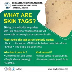 This educational graphic defines skin tags, or acrochordons, and lists common areas they appear. It also explains the typical causes and demographics, such as friction, hormones, and age.