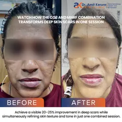 For deep, stubborn scars, I often combine treatments for the best results. This before-and-after shows a visible 20-25% improvement in deep scars after just one session combining CO2 Fractional Laser and MNRF, two powerful technologies that remodel the skin from within.