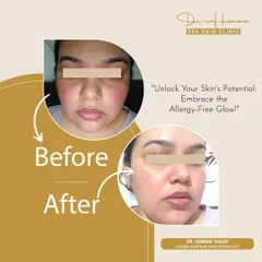 Skin allergies can be incredibly frustrating, causing redness, irritation, and discomfort. This client was struggling with persistent allergic reactions. Through a targeted treatment plan, we were able to calm the inflammation and restore her skin's natural barrier, revealing a clear and healthy complexion.