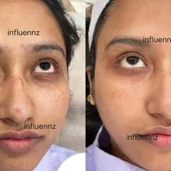 This transformation focuses on reducing dark circles and freckles. The 'after' image shows a brighter under-eye area and a visible reduction in pigmentation, leading to a more even and refreshed skin tone.