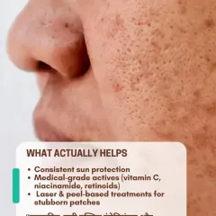 What actually helps reduce pigmentation? Consistent sun protection is non-negotiable. We also use medical-grade actives like Vitamin C and retinoids, along with professional laser and peel treatments for stubborn patches.