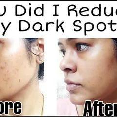 Many of you asked how I reduced my dark spots, so I wanted to share my journey. This image shows the difference after consistently using my DIY dark spot removal treatments. The spots have faded significantly, and my skin looks clearer and healthier.