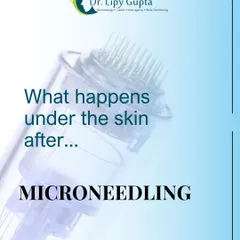 Ever wonder what happens under your skin after microneedling? This series explains the science. Immediately, the micro-channels trigger a healing response.