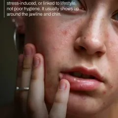 Adult acne, often appearing on the jawline and chin, is typically linked to internal factors like hormones or stress, not poor hygiene. Over-the-counter products can often worsen the inflammation.